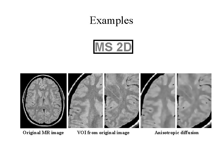 Examples MS 2 D Original MR image VOI from original image Anisotropic diffusion 