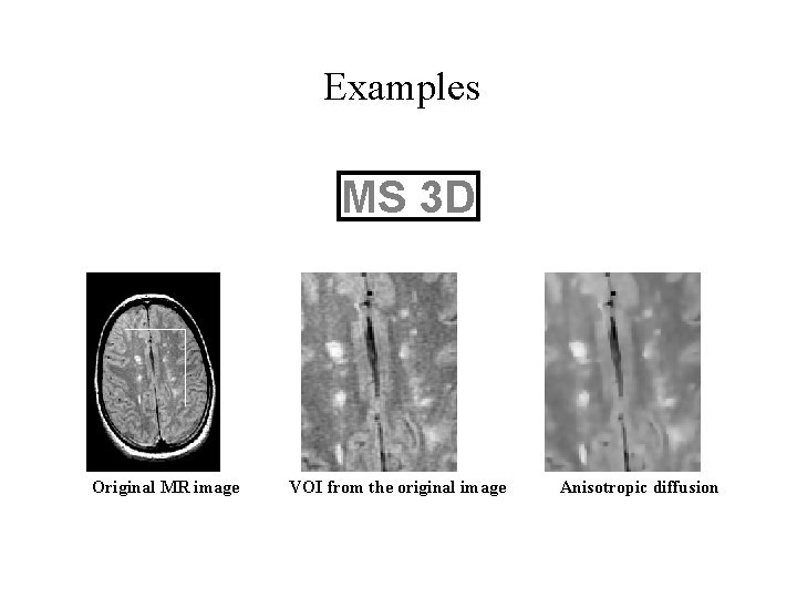 Examples MS 3 D Original MR image VOI from the original image Anisotropic diffusion