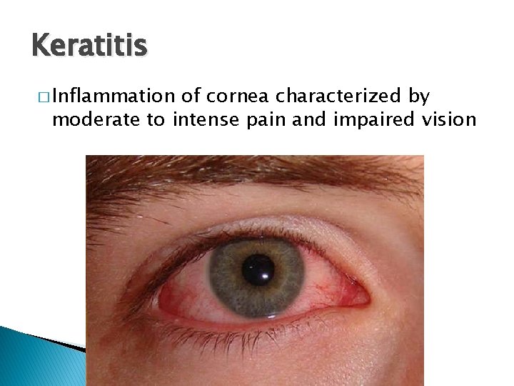 Keratitis � Inflammation of cornea characterized by moderate to intense pain and impaired vision