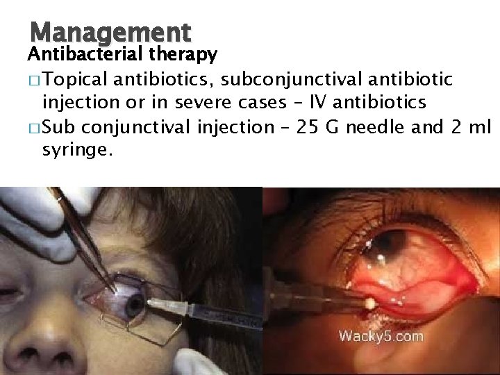 Management Antibacterial therapy � Topical antibiotics, subconjunctival antibiotic injection or in severe cases –