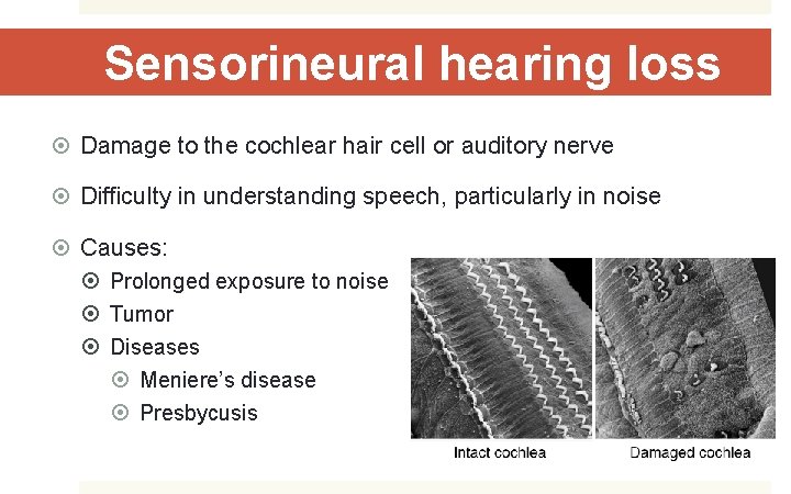 Sensorineural hearing loss Damage to the cochlear hair cell or auditory nerve Difficulty in