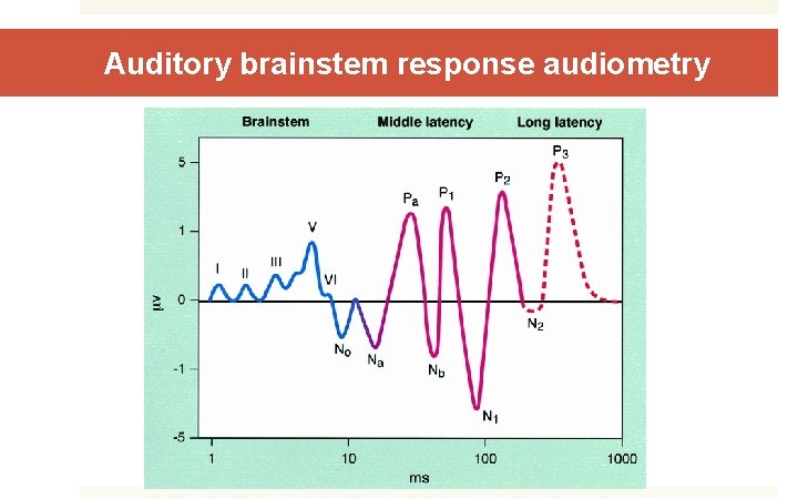 Auditory brainstem response audiometry 