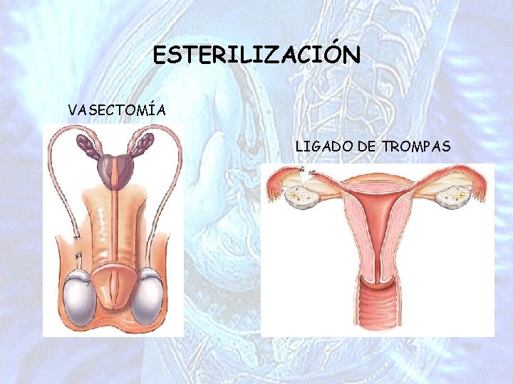 ESTERILIZACIÓN VASECTOMÍA LIGADO DE TROMPAS 