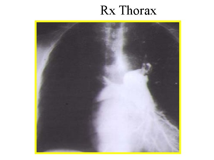 Rx Thorax 