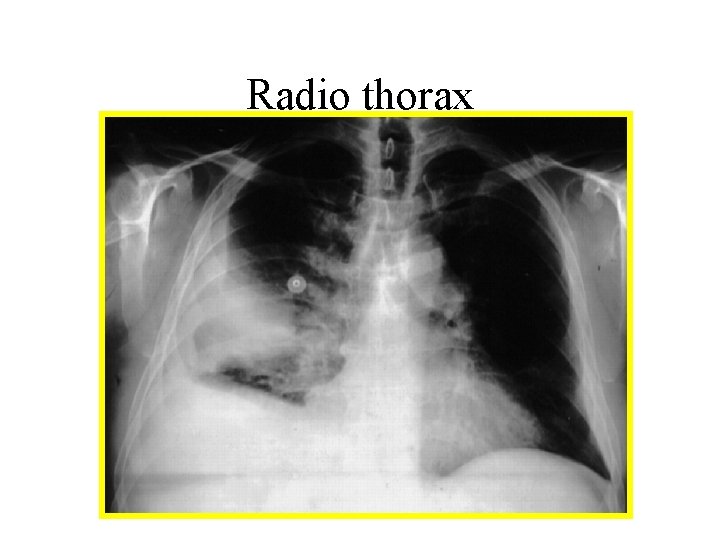 Radio thorax 