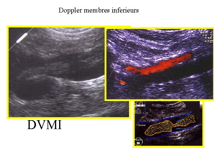 Doppler membres inferieurs DVMI 