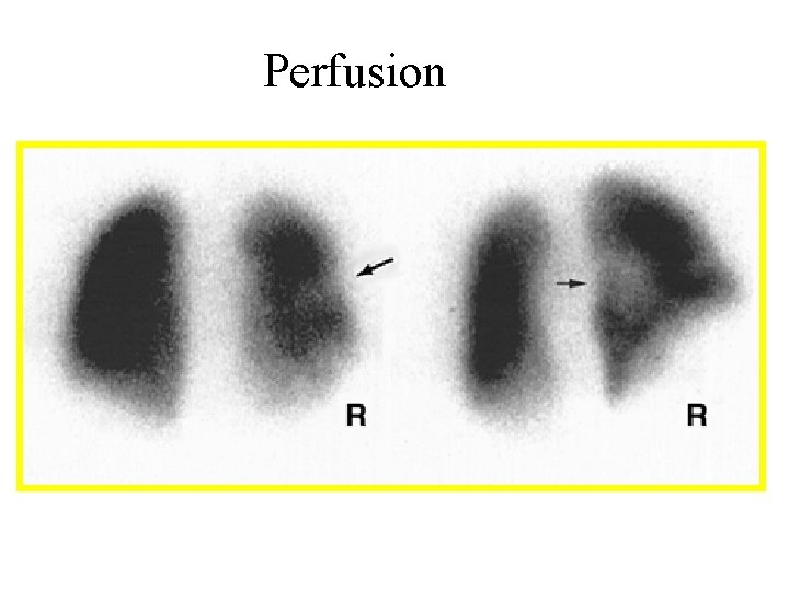 Perfusion 