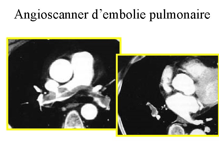 Angioscanner d’embolie pulmonaire 