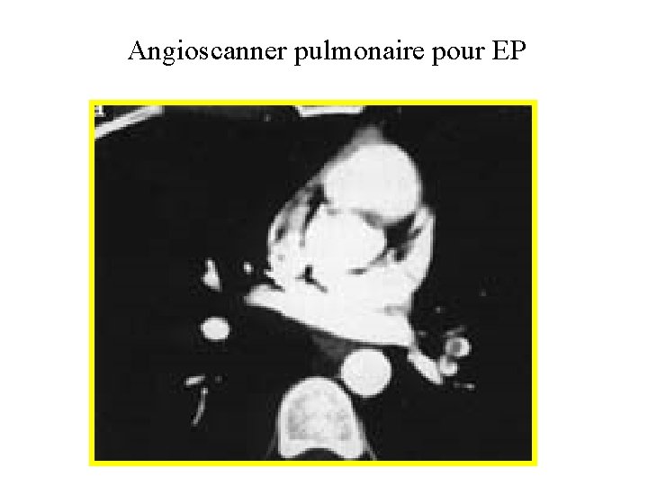 Angioscanner pulmonaire pour EP 