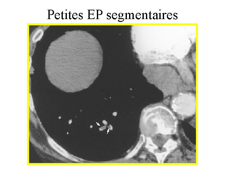 Petites EP segmentaires 