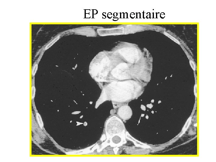 EP segmentaire 