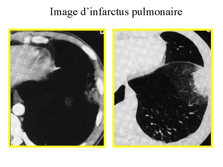 Image d’infarctus pulmonaire 