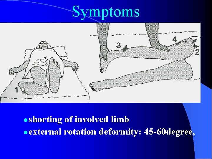 Symptoms shorting of involved limb l external rotation deformity: 45 -60 degree, l 