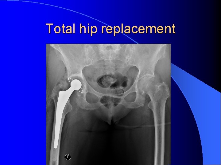 Total hip replacement 
