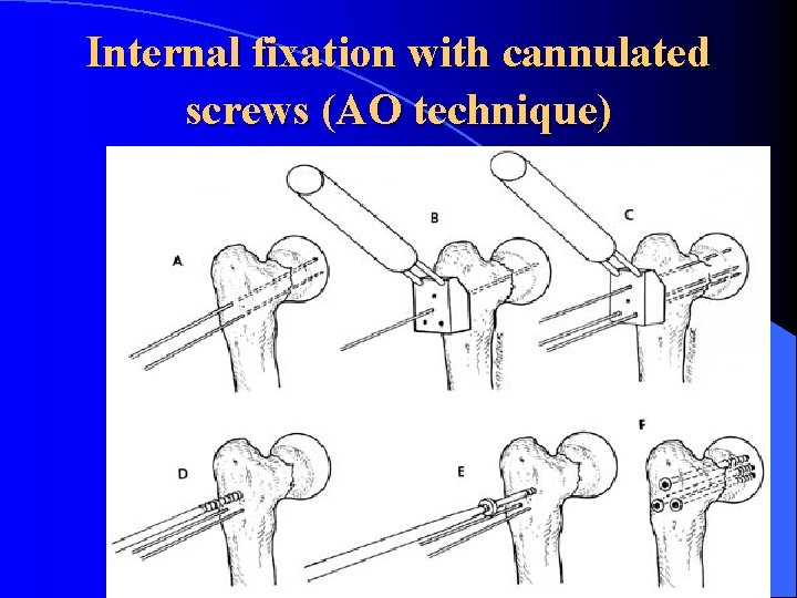 Internal fixation with cannulated screws (AO technique) 