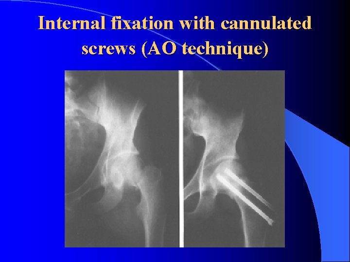 Internal fixation with cannulated screws (AO technique) 
