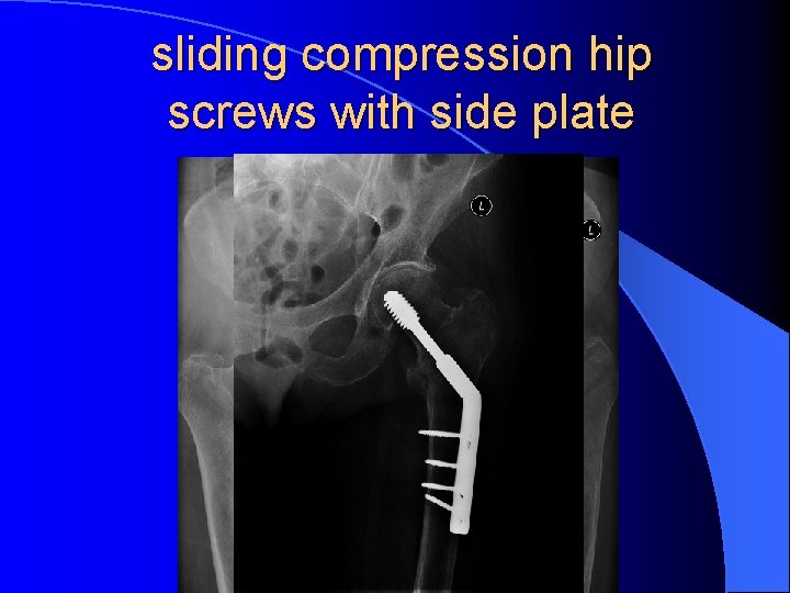 sliding compression hip screws with side plate 