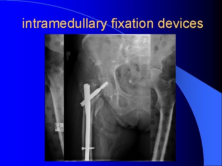 intramedullary fixation devices 