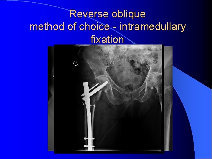 Reverse oblique method of choice - intramedullary fixation 