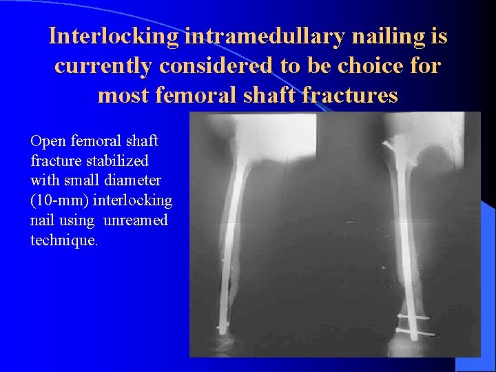 Interlocking intramedullary nailing is currently considered to be choice for most femoral shaft fractures