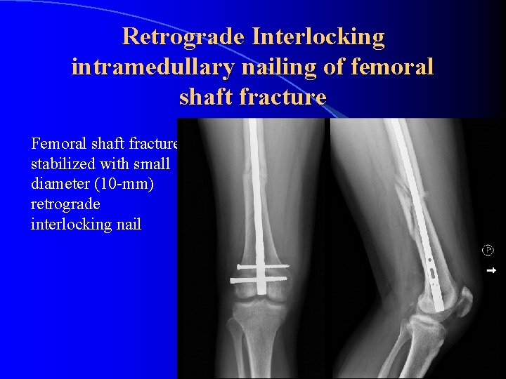 Retrograde Interlocking intramedullary nailing of femoral shaft fracture Femoral shaft fracture stabilized with small
