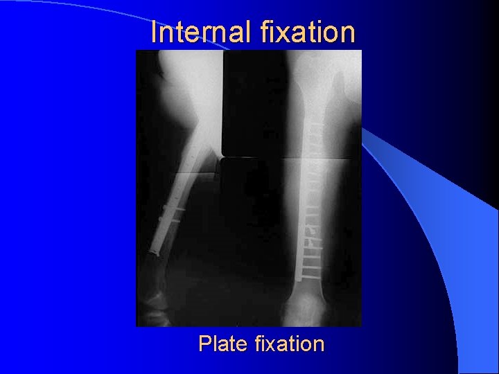 Internal fixation OPERACYJNE Plate fixation 