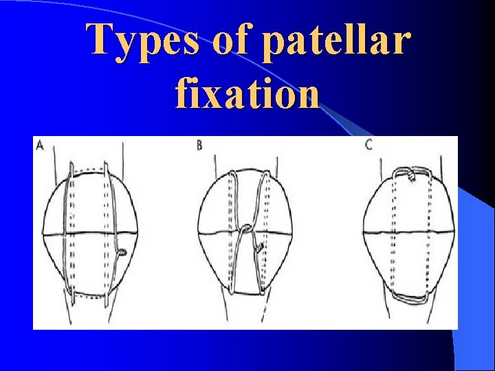 Types of patellar fixation 