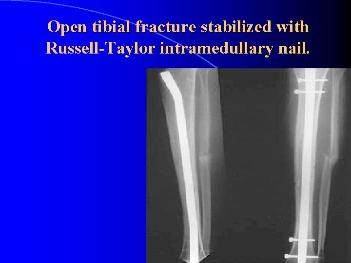Open tibial fracture stabilized with Russell-Taylor intramedullary nail. 