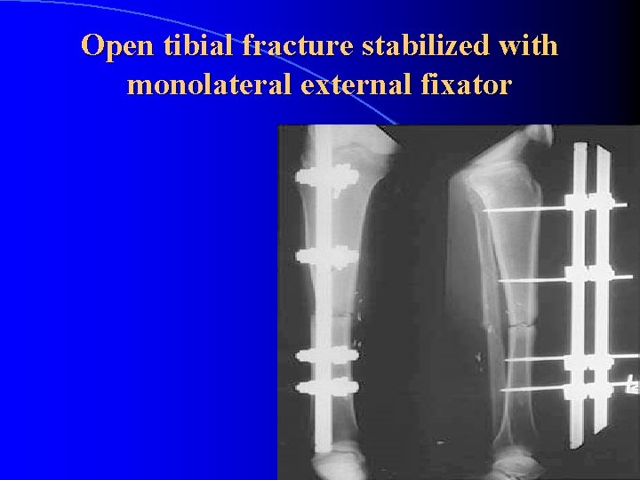 Open tibial fracture stabilized with monolateral external fixator 