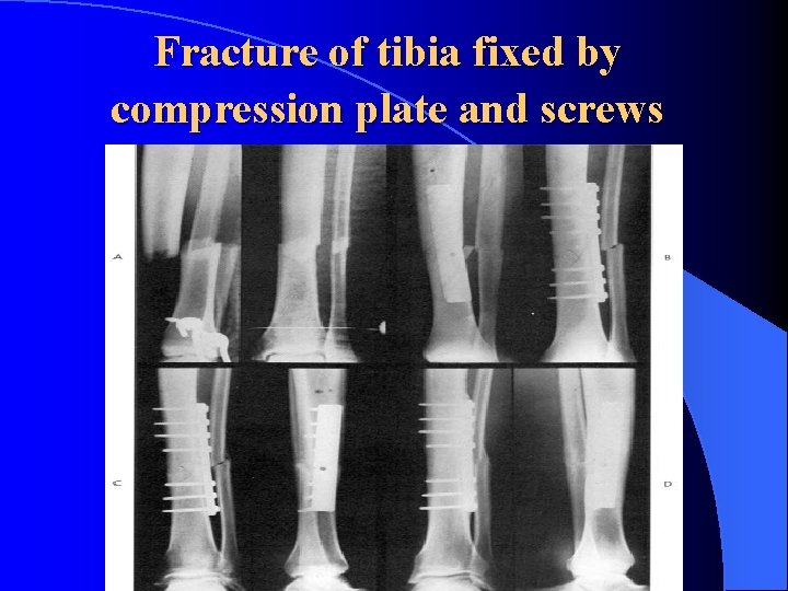 Fracture of tibia fixed by compression plate and screws 