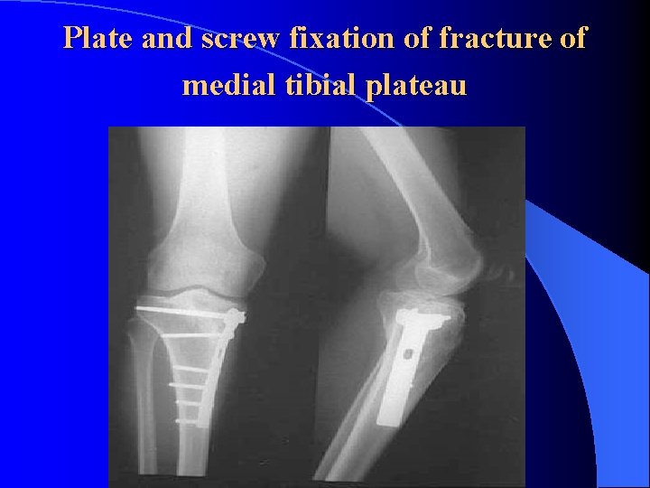 Plate and screw fixation of fracture of medial tibial plateau 