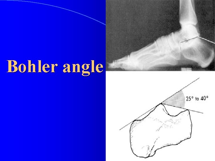 Bohler angle 