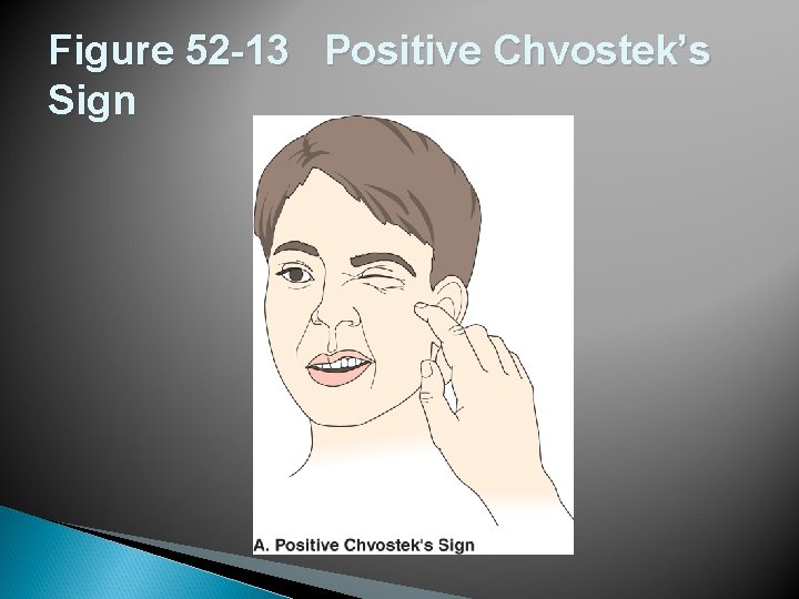 Figure 52 -13 Positive Chvostek’s Sign 