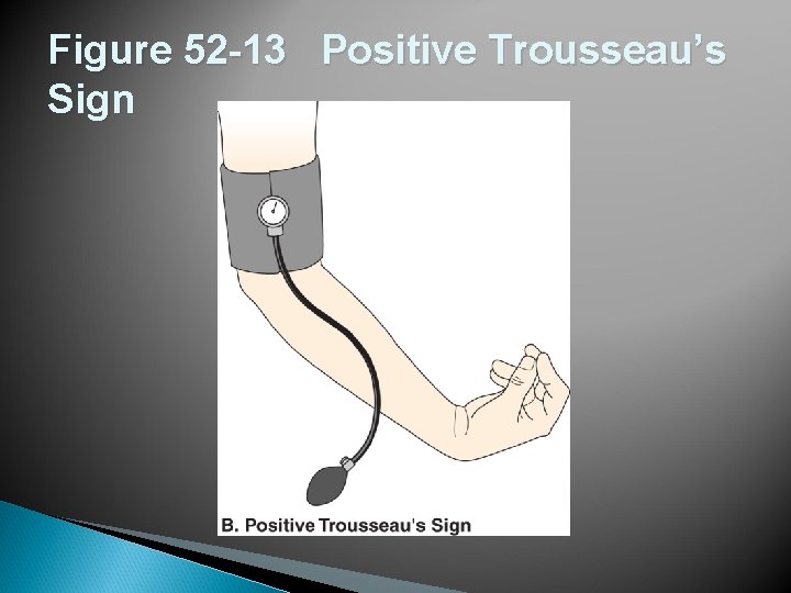 Figure 52 -13 Positive Trousseau’s Sign 
