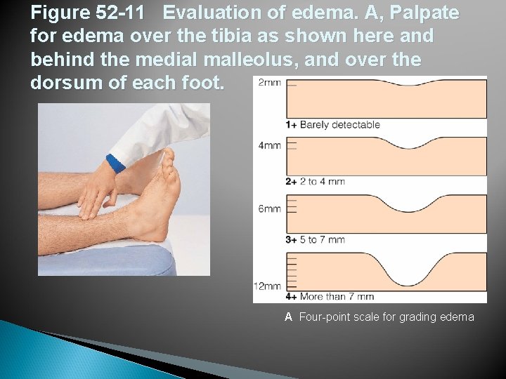 Figure 52 -11 Evaluation of edema. A, Palpate for edema over the tibia as