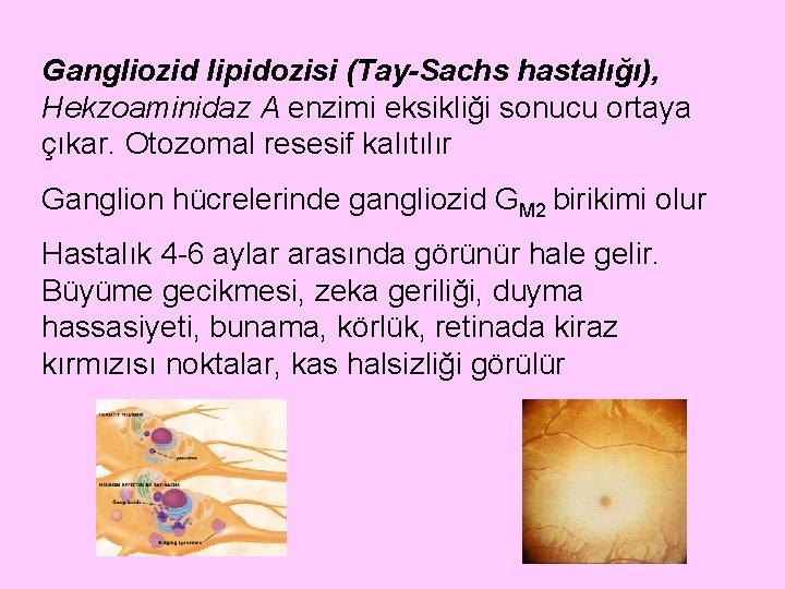 Gangliozid lipidozisi (Tay-Sachs hastalığı), Hekzoaminidaz A enzimi eksikliği sonucu ortaya çıkar. Otozomal resesif kalıtılır