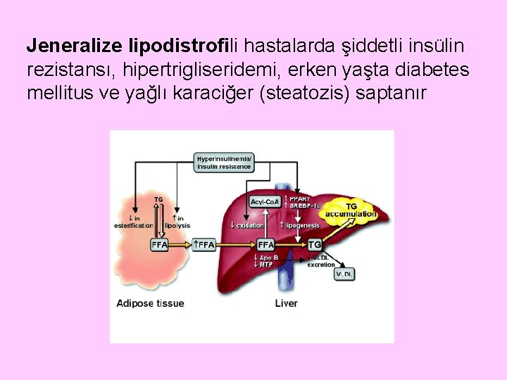 Jeneralize lipodistrofili hastalarda şiddetli insülin rezistansı, hipertrigliseridemi, erken yaşta diabetes mellitus ve yağlı karaciğer