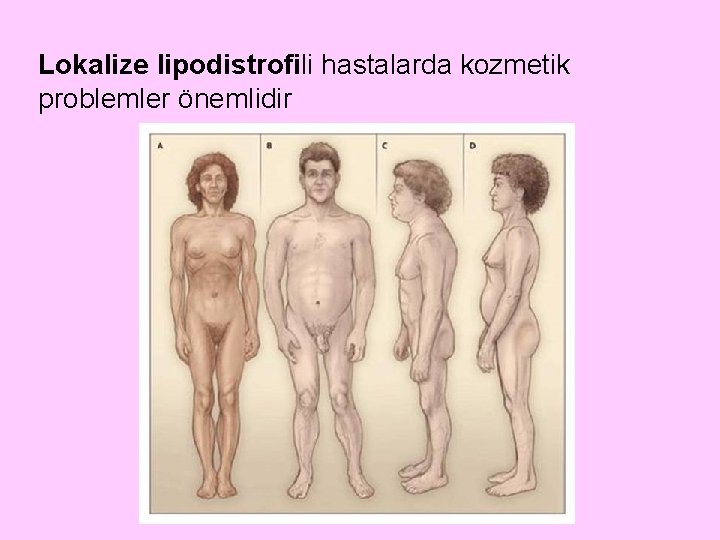 Lokalize lipodistrofili hastalarda kozmetik problemler önemlidir 