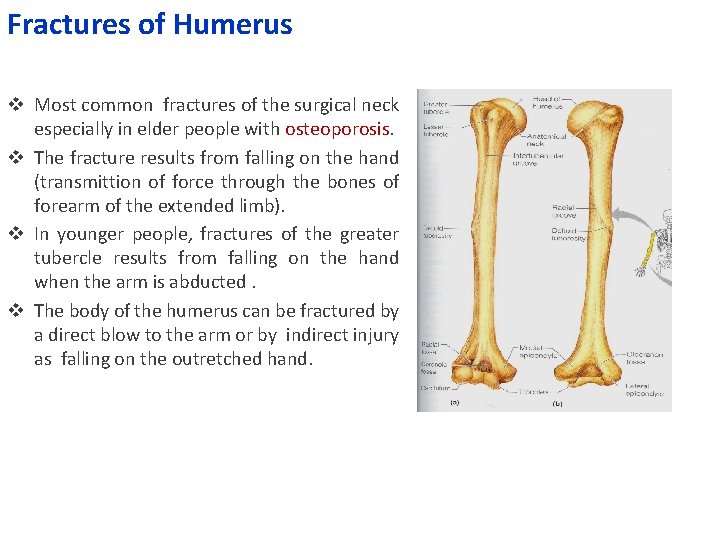 Fractures of Humerus v Most common fractures of the surgical neck especially in elder