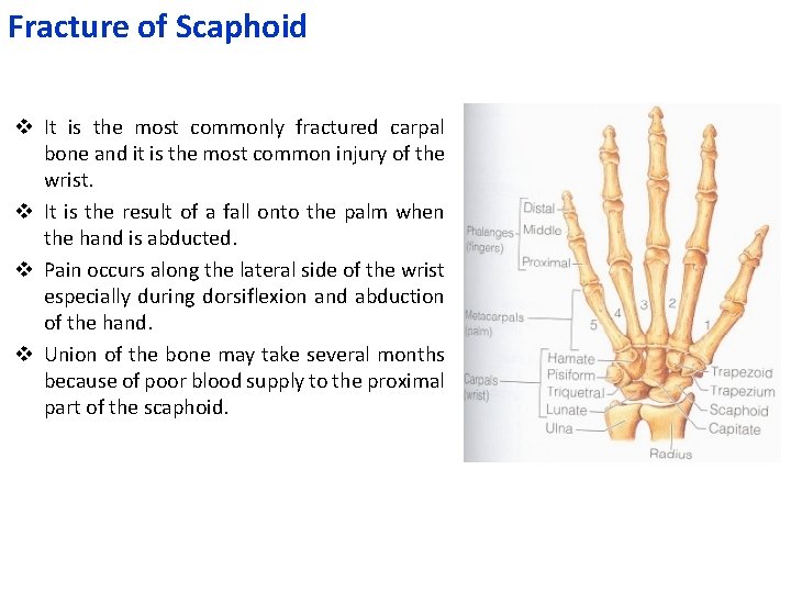 Fracture of Scaphoid v It is the most commonly fractured carpal bone and it