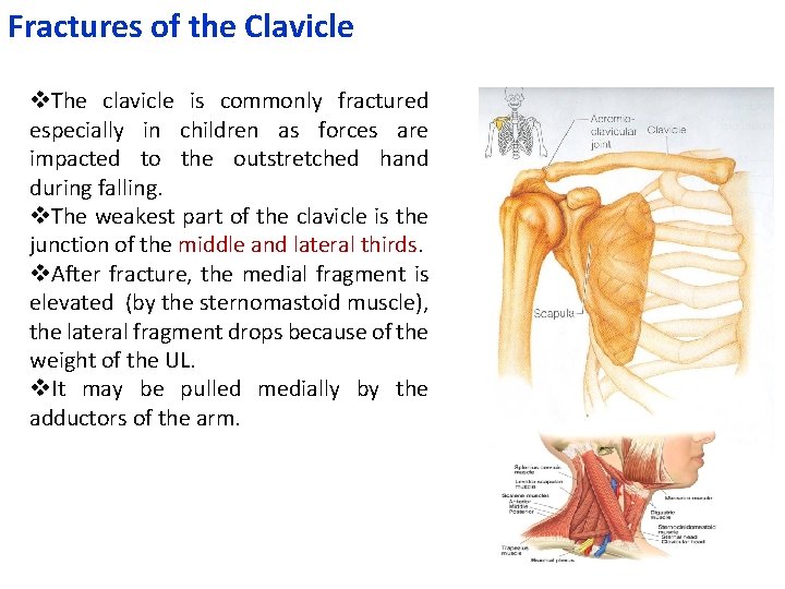 Fractures of the Clavicle v. The clavicle is commonly fractured especially in children as