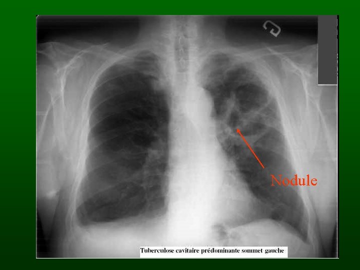 Nodule 