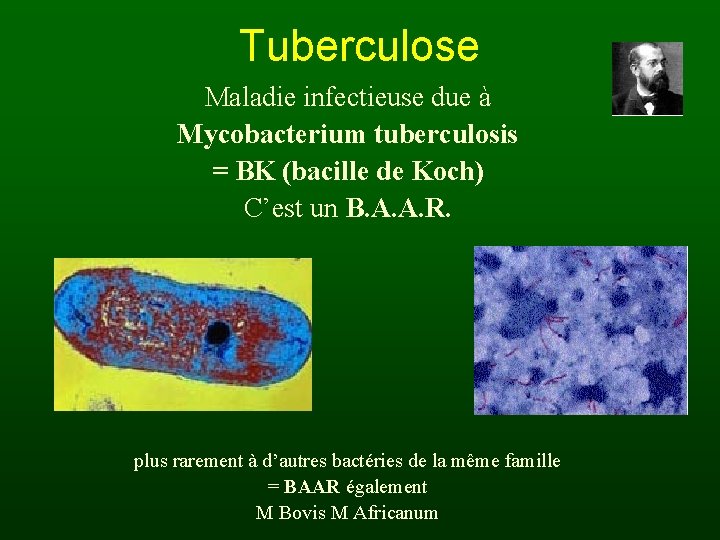 Tuberculose Maladie infectieuse due à Mycobacterium tuberculosis = BK (bacille de Koch) C’est un