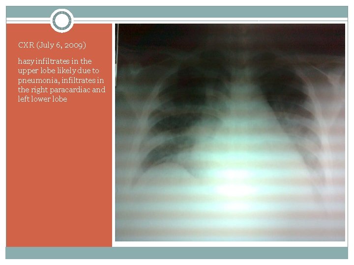 CXR (July 6, 2009) hazy infiltrates in the upper lobe likely due to pneumonia,