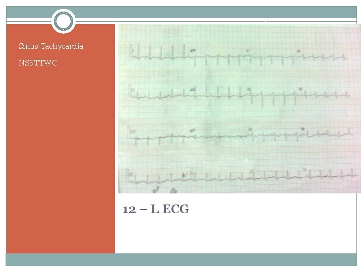 Sinus Tachycardia NSSTTWC 12 – L ECG 