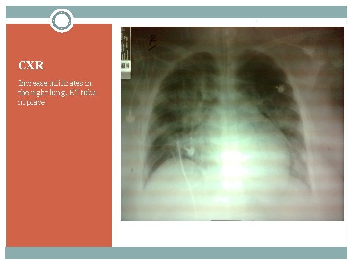 CXR Increase infiltrates in the right lung. ET tube in place 