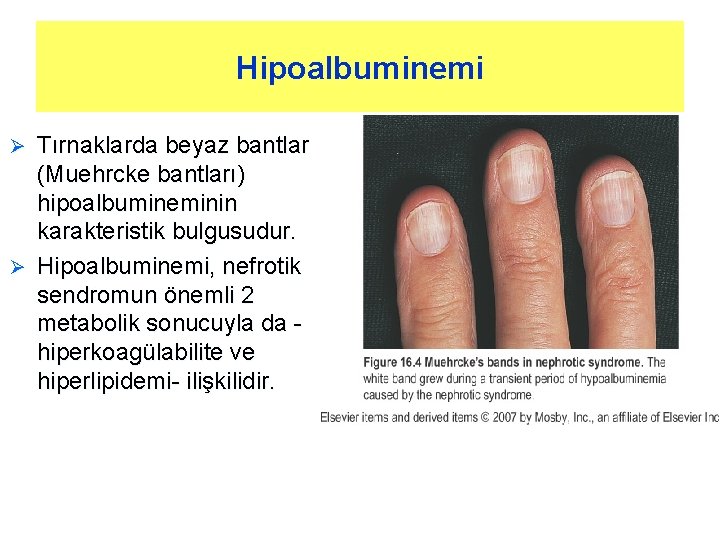 Hipoalbuminemi Tırnaklarda beyaz bantlar (Muehrcke bantları) hipoalbumineminin karakteristik bulgusudur. Ø Hipoalbuminemi, nefrotik sendromun önemli