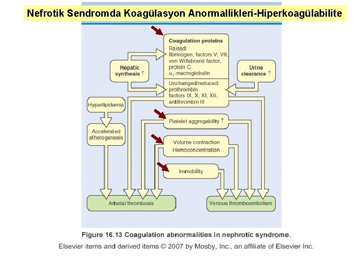 Nefrotik Sendromda Koagülasyon Anormallikleri-Hiperkoagülabilite 