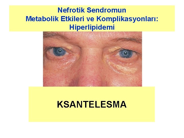 Nefrotik Sendromun Metabolik Etkileri ve Komplikasyonları: Hiperlipidemi KSANTELESMA 