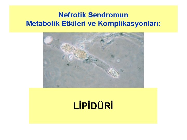 Nefrotik Sendromun Metabolik Etkileri ve Komplikasyonları: LİPİDÜRİ 